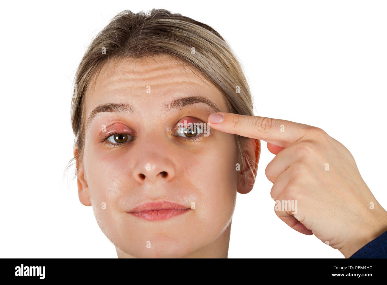 Inflammation Des Paupieres Banque D Image Et Photos Alamy