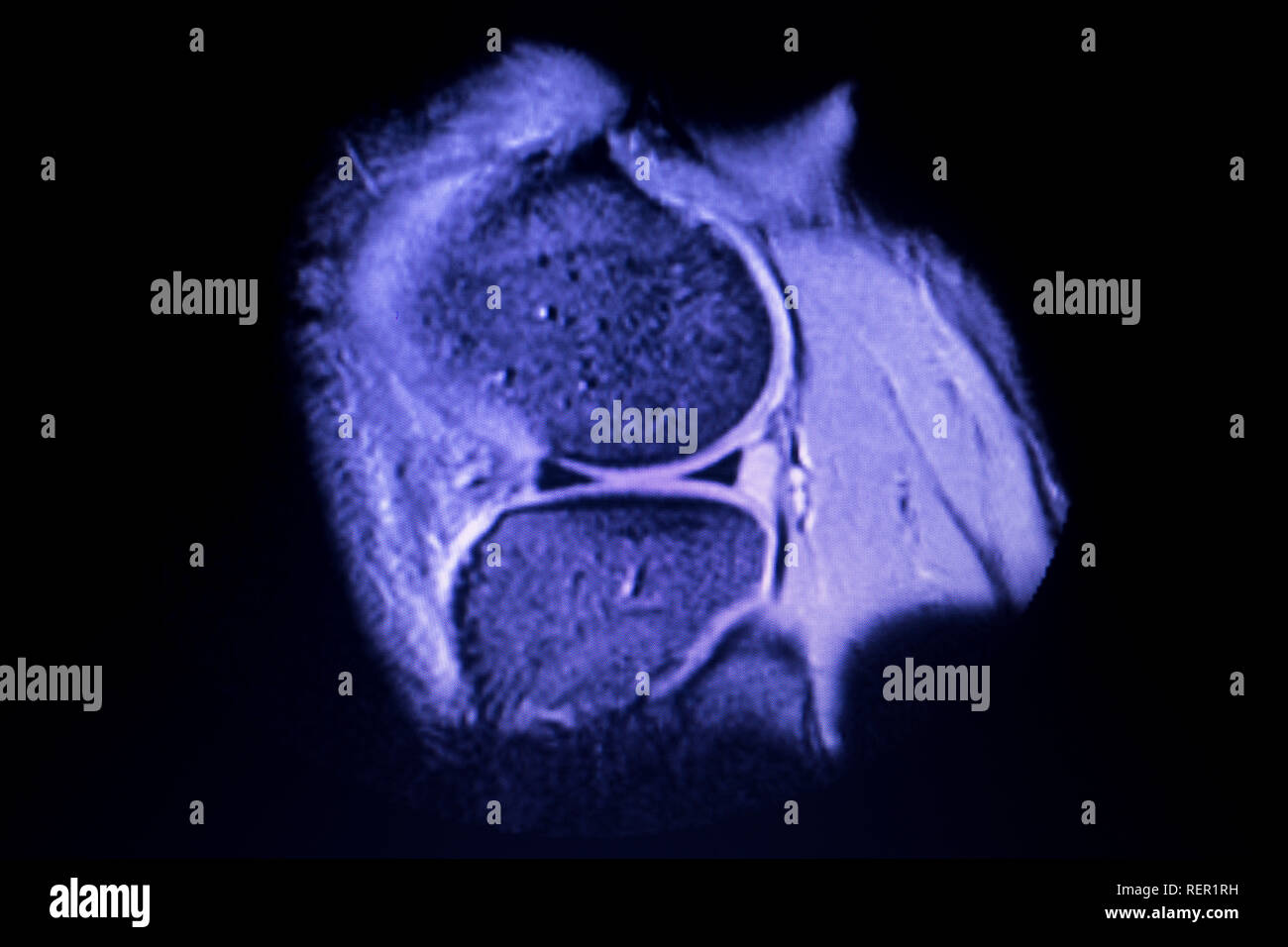 L'imagerie par résonance magnétique IRM GENOU corne postérieure du ménisque interne normale scantest résultats. Banque D'Images