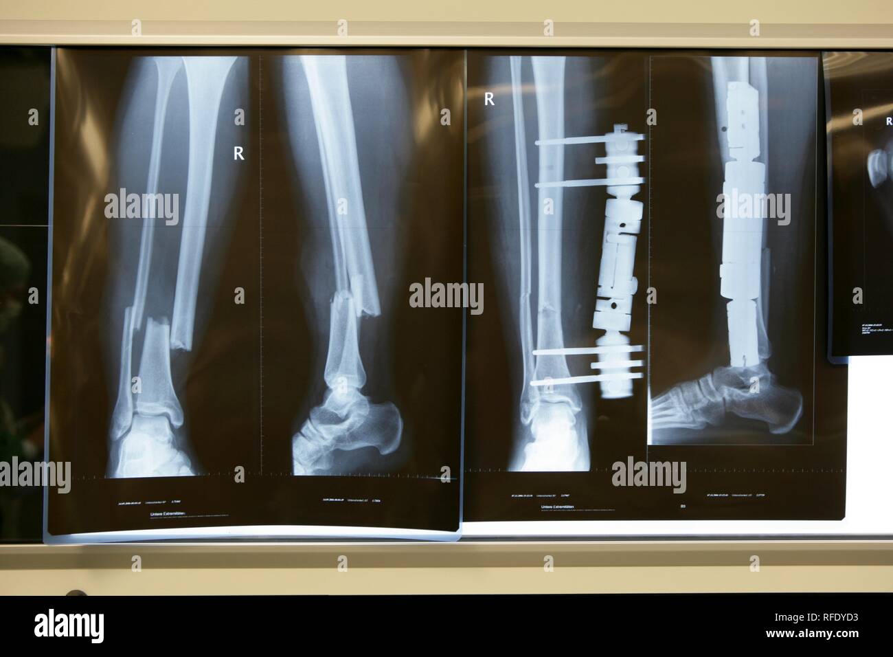 Radiographie d'une fracture de la jambe et une fixation externe Banque D'Images