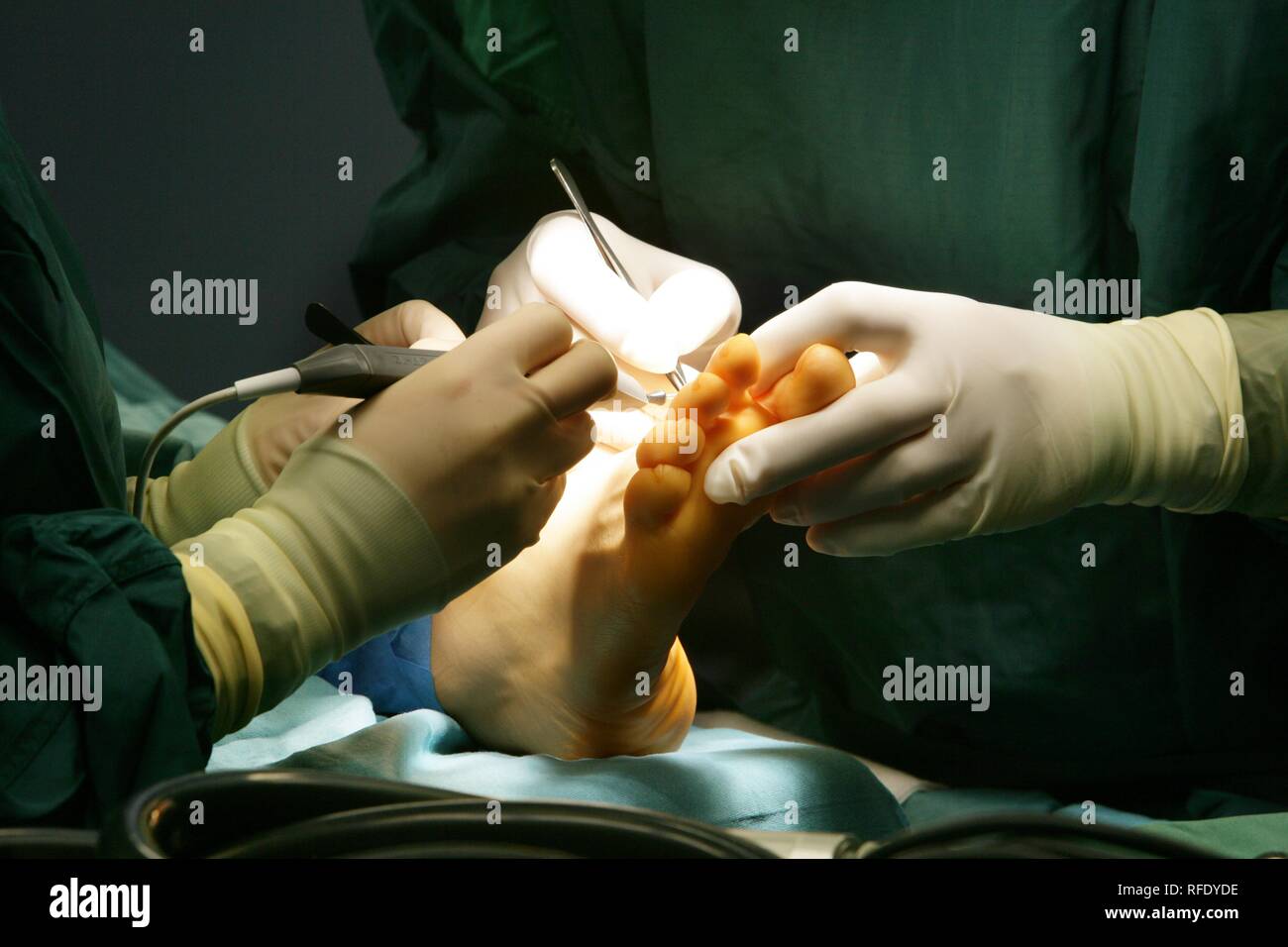 La chirurgie, la correction d'un pied Banque D'Images