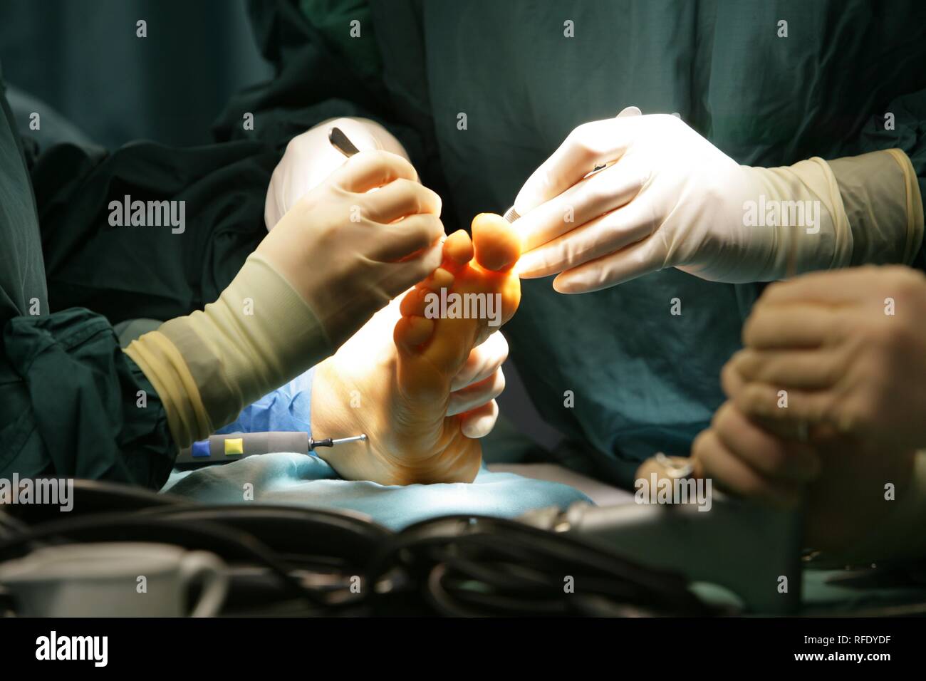 La chirurgie, la correction d'un pied Banque D'Images