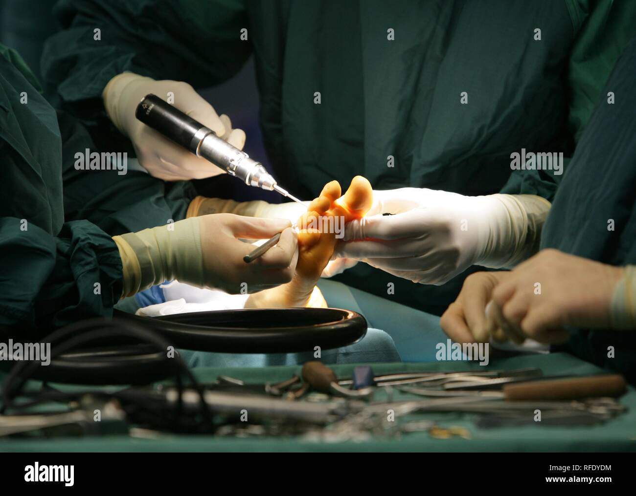 La chirurgie, la correction d'un pied Banque D'Images