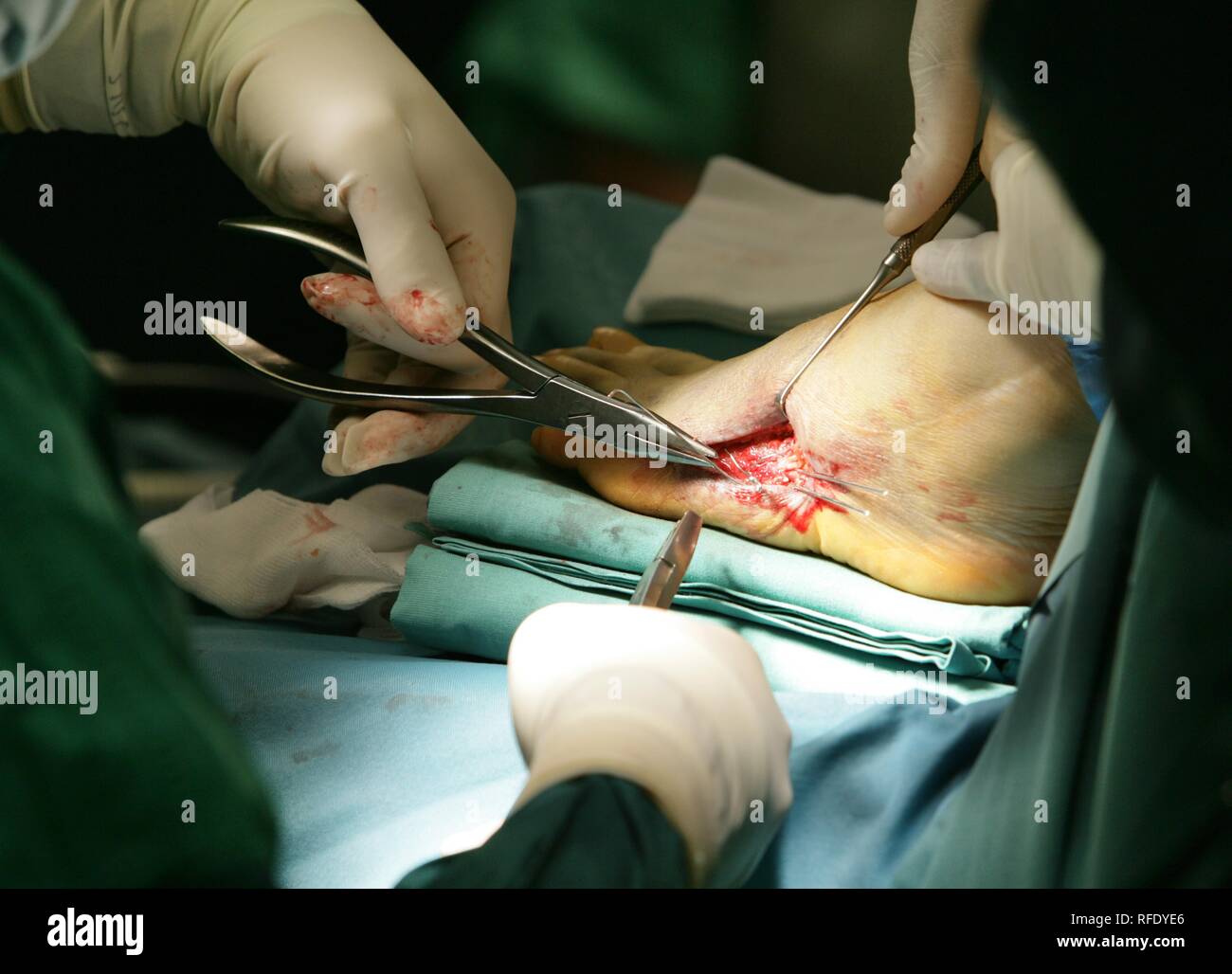 La chirurgie, la correction d'un pied Banque D'Images