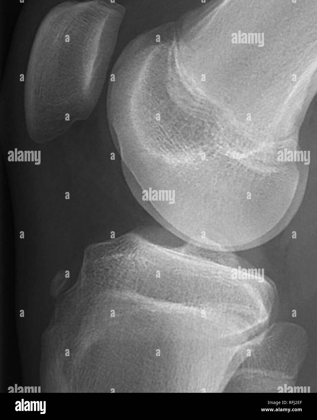 Fracture-avulsion de la tubérosité tibiale. Banque D'Images