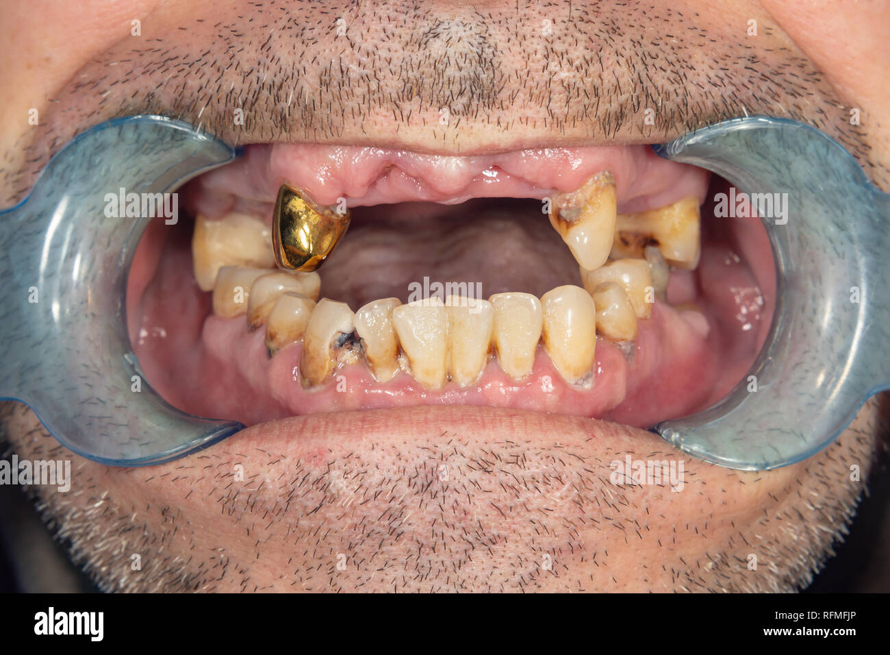 Dents pourries, de la carie et de la plaque dentaire close-up dans un asocially mauvais patient. Le concept d'une mauvaise hygiène et des problèmes de santé Banque D'Images