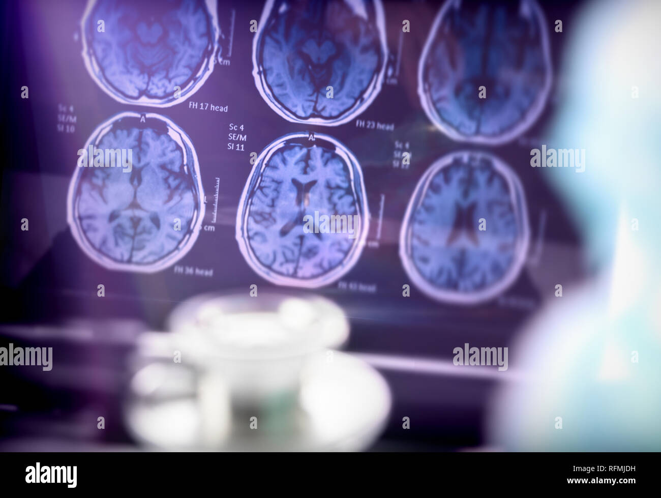 L'analyse scientifique de la maladie d'Alzheimer à l'hôpital, conceptual image Banque D'Images