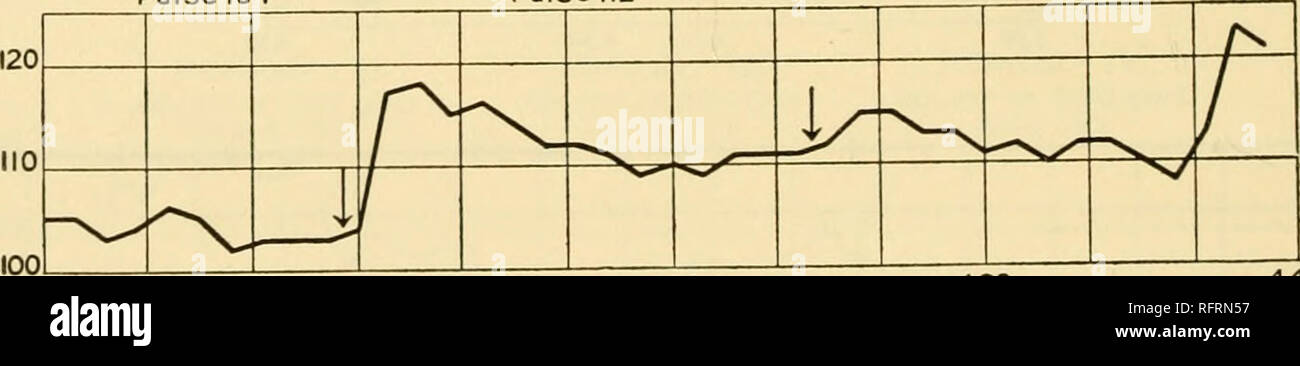 . Carnegie Institution of Washington publication. Fig. 51. Le taux d'impulsion et kymograph courbes pour J. M., le 4 avril 1913. Avec l'enfant E. N., trois périodes avec une activité d'I ont été déposés dans l'ordre le 26 mai 1913 (voir la figure 52). Le taux d'impulsion dans la période I de 3h 21m p. m. à 3h 41m p. m. était 104 et la période du carbone - JE C02pemr 4,50 qms 104 impulsions-PÉRIODE II C02pernr 112 gms 4,82 Période d'impulsion-III CO^perhr 4.84 gms 113 impulsions. 3.22  +MH JE jfrtyPlf*' "^ t" E.N MAI26.I9I3 Fig. 52. Le taux d'impulsion et de courbes pour kymograph E. N., 26 mai 1913.. Veuillez noter que ces images sont extra Banque D'Images