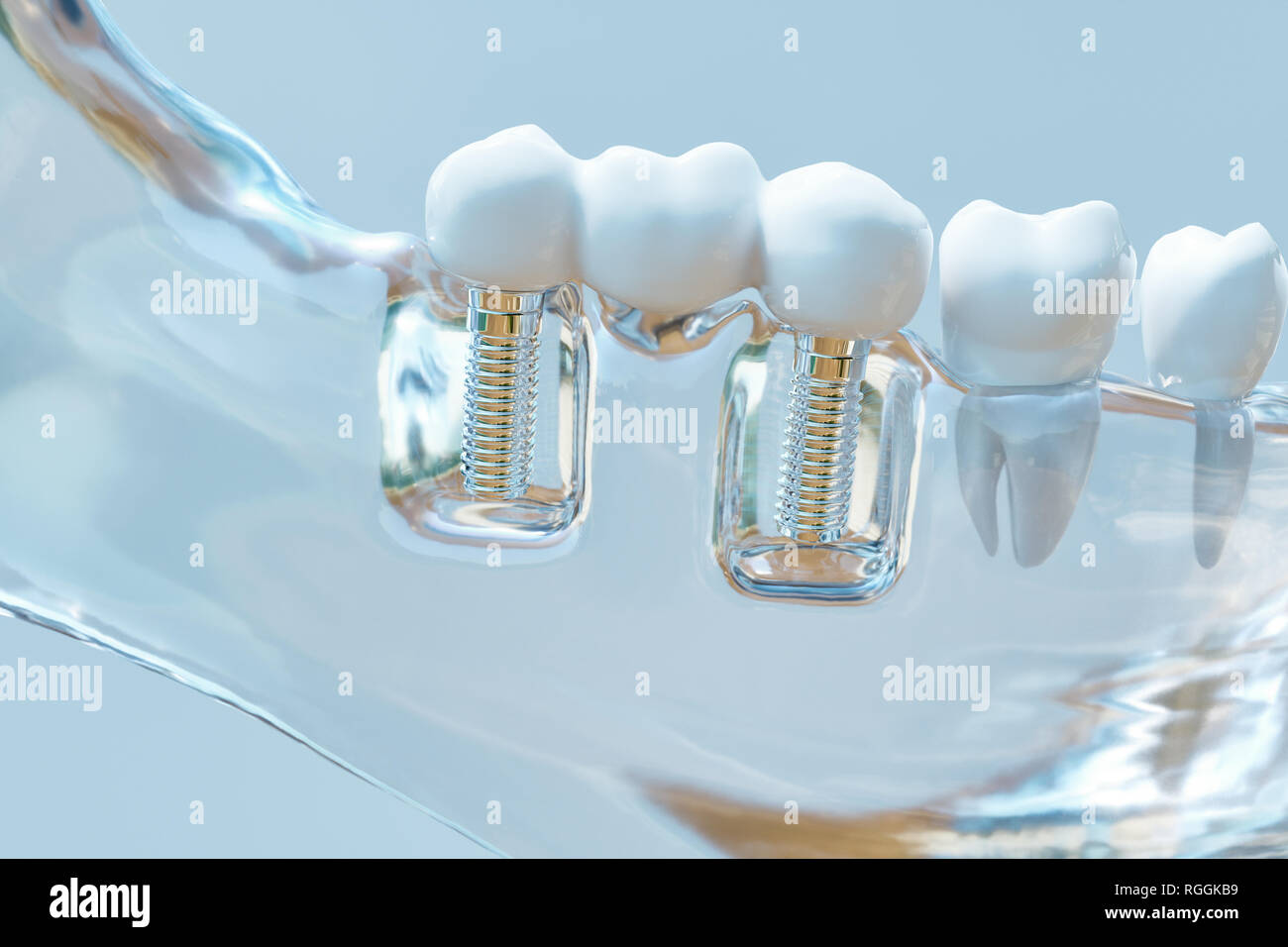 Des dents implant - le rendu 3D Banque D'Images