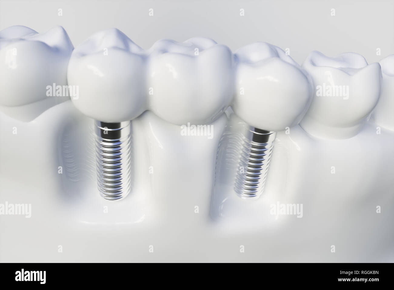 Des dents implant - le rendu 3D Banque D'Images