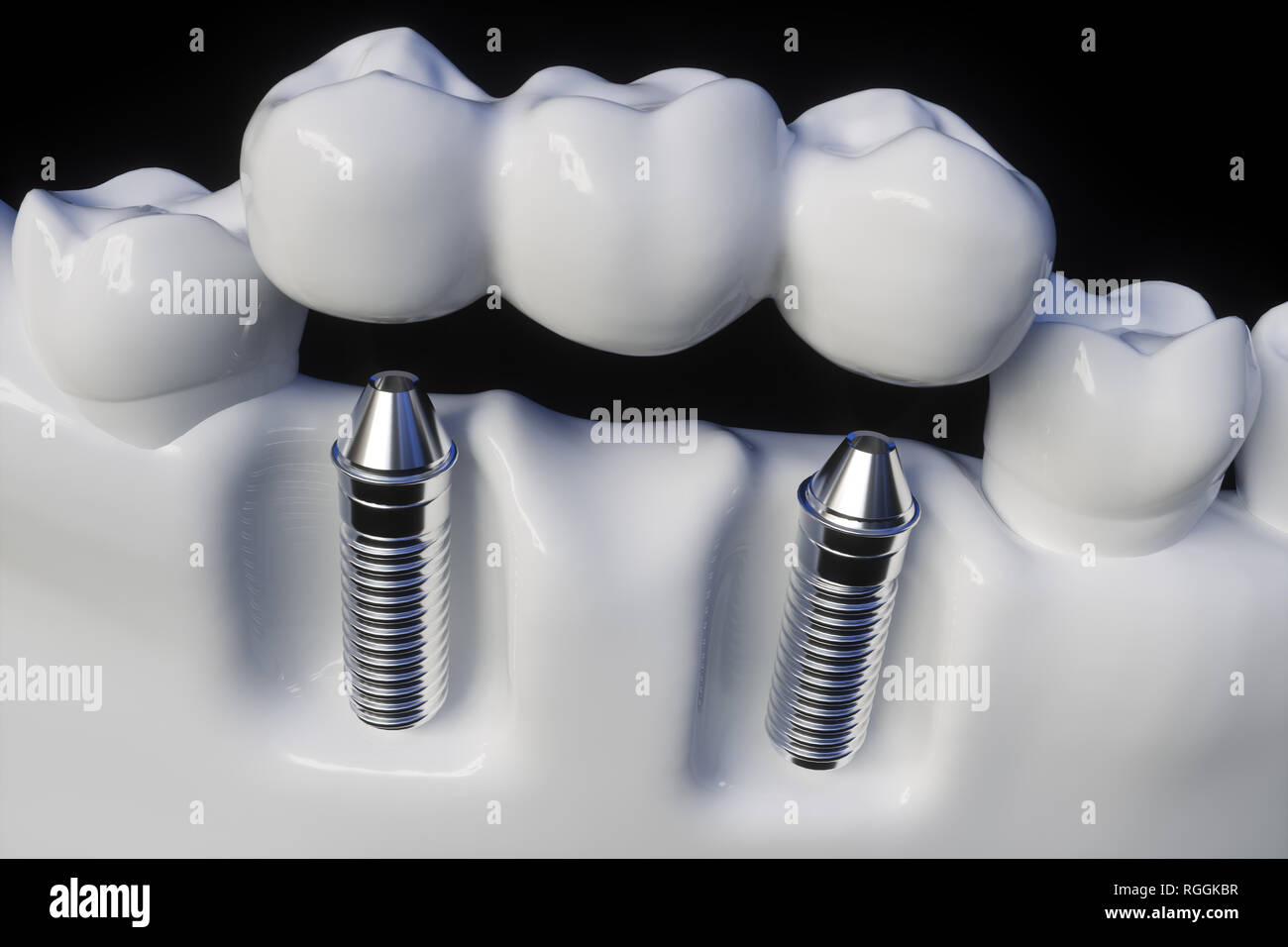Des dents implant - le rendu 3D Banque D'Images