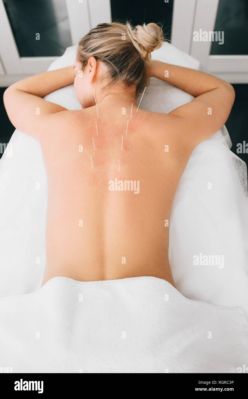 Caucasian woman ayant un traitement d'acupuncture traditionnelle chinoise. Femelle avec aiguille d'acupuncture, vue de dessus Banque D'Images