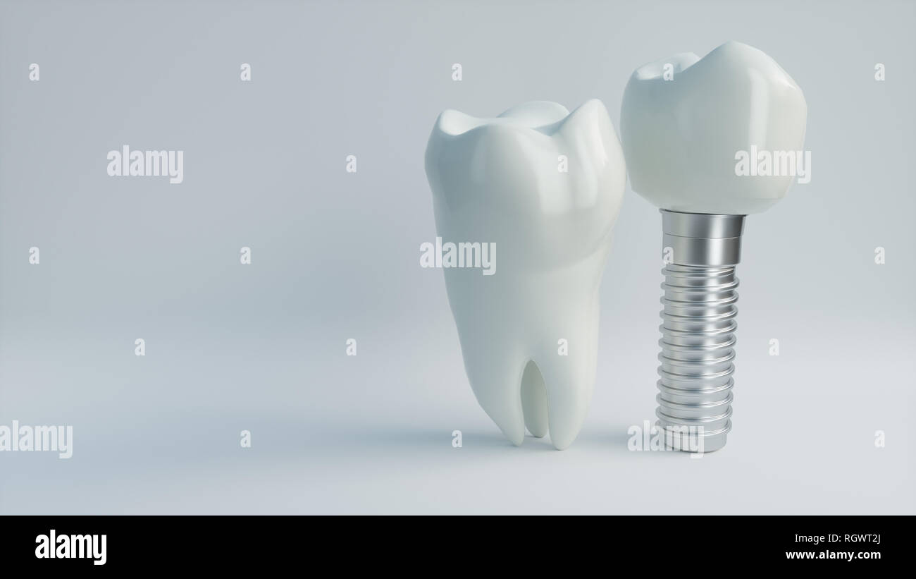 Des dents implant - le rendu 3D Banque D'Images