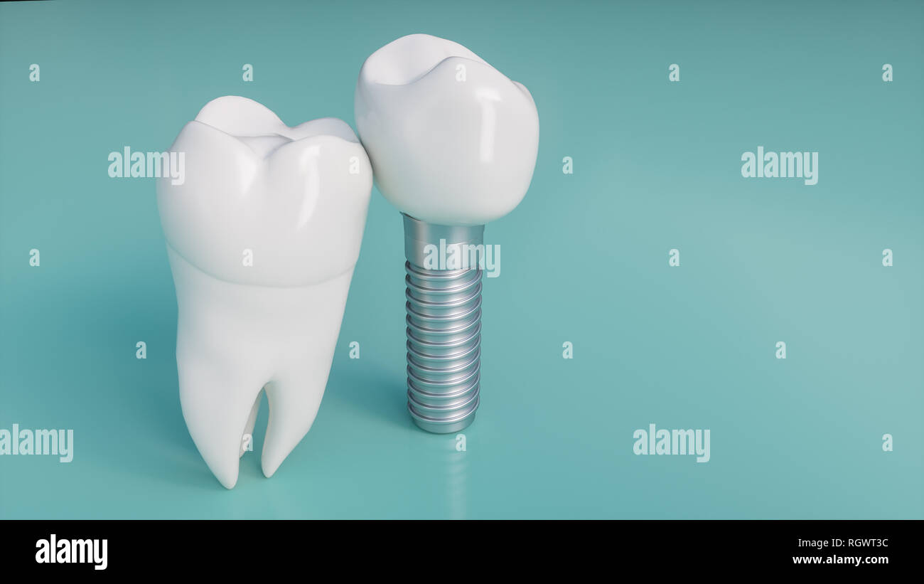 Des dents implant - le rendu 3D Banque D'Images