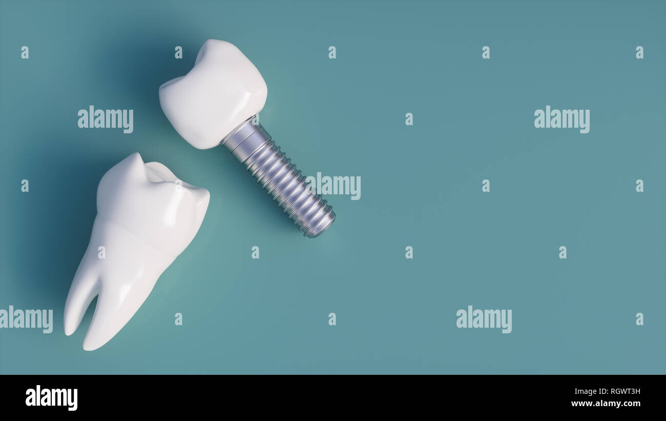 Des dents implant - le rendu 3D Banque D'Images