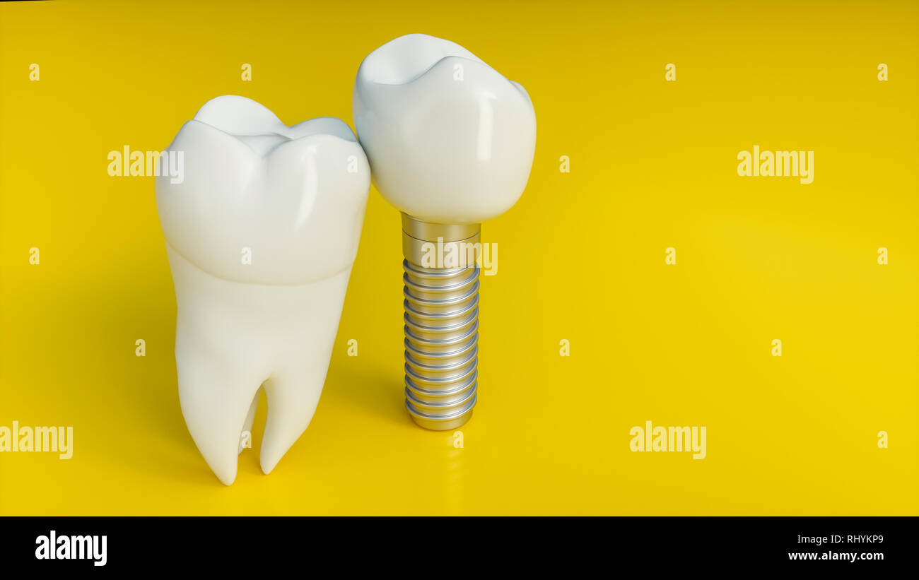 Des dents implant. Dents humaines ou prothèses dentaires sur fond jaune -- 3D Rendering Banque D'Images