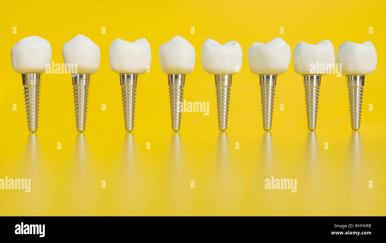 Des dents implant. Dents humaines ou prothèses dentaires sur fond jaune -- 3D Rendering Banque D'Images