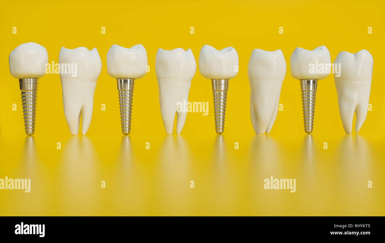 Des dents implant. Dents humaines ou prothèses dentaires sur fond jaune -- 3D Rendering Banque D'Images