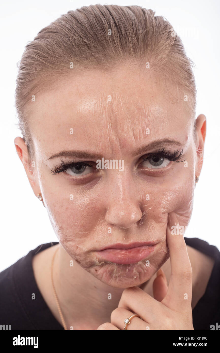 Visage de femme avec la peau brûlée après peeling chimique Photo Stock Alamy