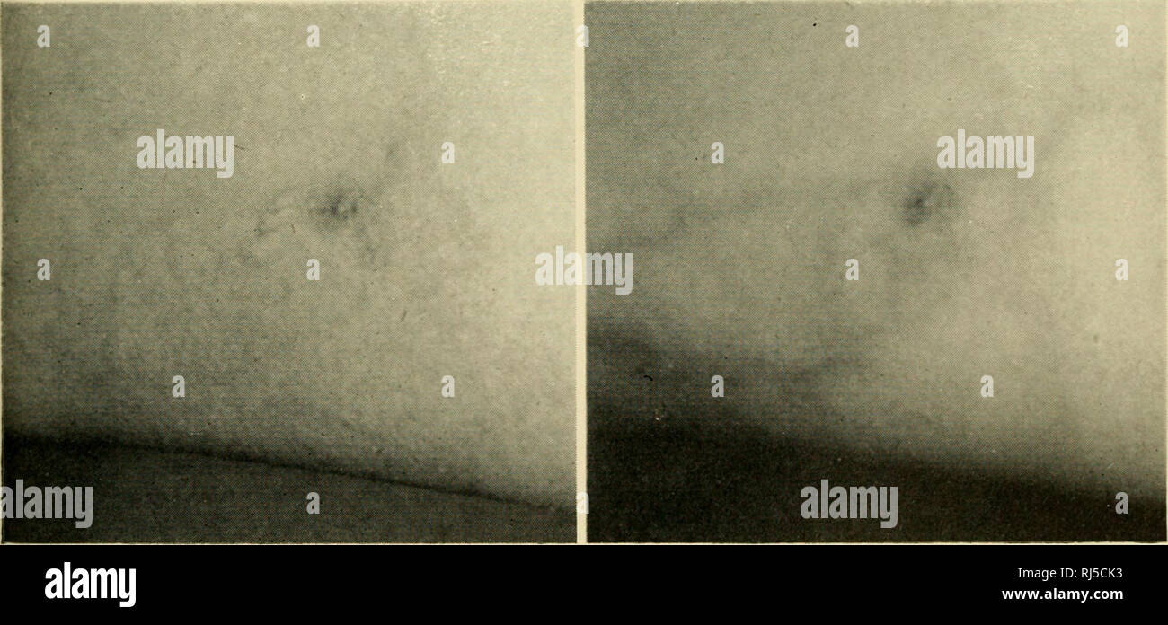 . Ciba Foundation colloques sur le vieillissement. La vieillesse ; vieillissement ; les animaux -- croissance &AMP ; développement. (A) (b). (C) (tl) FK ;. 1. (A) les araignées artériel de la peau. J'wiiite et noir)hotoraph. (B) même zone oi' la peau showino l'échec des grandes artères, des araignées à l'afficher dans une photographie infrarouge, et l'emplacement des lésions des veines, (c) par une étoile. Photographie noir et blanc, (d) par une étoile. Photoorai infra rouge)h montrant connexion^^ de la lésion avec les nervures à laquelle elle est tributaire. [ Pour faire face à jxige S 0. Veuillez noter que ces images sont extraites de la page numérisée des images qui m Banque D'Images