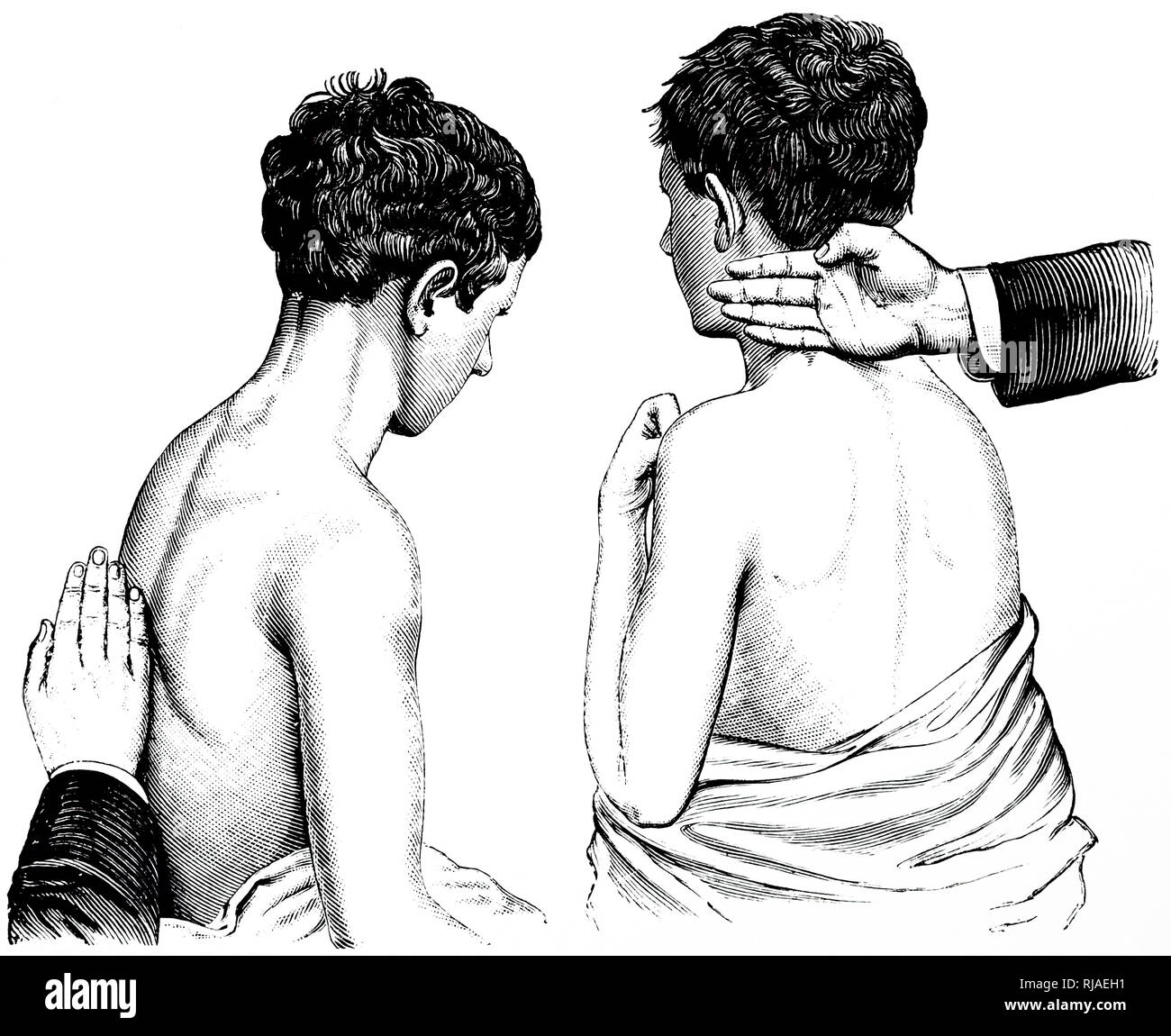 Une gravure représentant un massage suédois : retour et de l'épaule du hachage. En date du 19e siècle Banque D'Images