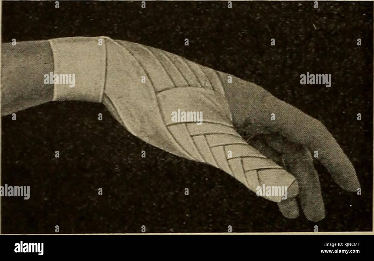 . Bactériologie et des techniques chirurgicales pour les infirmières. Soins infirmiers ; opérations chirurgicales, la chirurgie, la bactériologie. 84 TECHNIQUE CHIRURGICALE inverse en spirale de doigt (je pouce par ij m).-La fin de la bandage est assurée par un ou deux tours du bandage autour du-phalangienne, et le bandage effectué vers le haut par spiral inversé tours jusqu'à la base du doigt est atteint. Terminer par la circulaire tourne. Utilisation.-pour maintenir les pansements sur les doigts. Bandage de pouce spica (je pouce par ij m).-Le bandage est fixé par la circulaire tourne autour du poignet. Le pansement est ensuite continué sur le dos de la main jusqu'à la pointe de th Banque D'Images