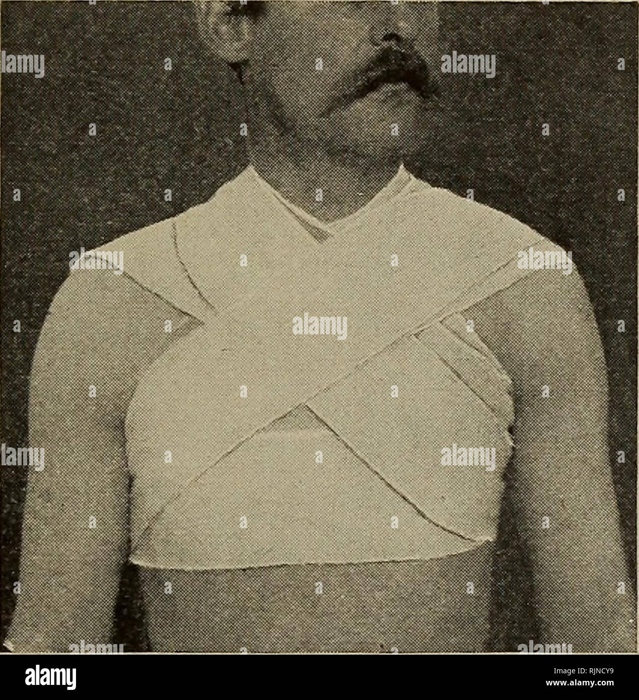 . Bactériologie et des techniques chirurgicales pour les infirmières. Soins infirmiers ; opérations chirurgicales, la chirurgie, la bactériologie. Des bandages et pansements 77 retour à leur point de départ. Continuer ces tours jusqu'à ce que le bandage est terminée (Fig. 18, 19). Utilise.âTo conserver les vinaigrettes sur la partie supérieure du dos et à tirer les épaules vers l'arrière. Vy- -v h .,# â , â : i *â€¢â â â â '1A : i. Fig. 18.âPosterior figure-de-8 bandage de la poitrine. (Fowler's Chirurgie.) Fig. 19.âAnterior figure-de-8 bandage de la poitrine. (Fowler). La chirurgie de l'Épaule Bandage Spica (2 pouces par 7 mètres). ÂFix le bandage par la circulaire tourne à l'inserti Banque D'Images