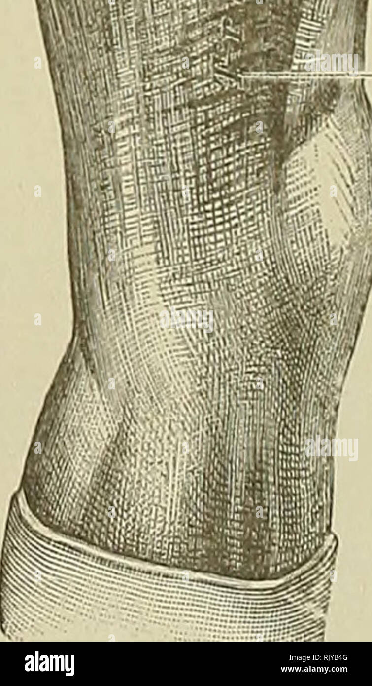 . Un atlas de l'anatomie humaine pour les étudiants et les médecins. L'anatomie. Cimier de l'ilium Crista iliaca colonne vertébrale antérieure et supérieure de l'ilium Spina iliaca tenseur antéro-supérieure ou vaginse femoris muscle tensor fasciae femoris M. tensor fasciae latas fascia profond de la cuisse, ou fascia lata (couche superficielle) fascia lata (superficiel) fascia profond du limbe de la cuisse, ou fascia lata- (couche superficielle) fascia lata (superficiel) limbe. Iliotibial band ligament ou Fig. 587.-fascia profond de la cuisse, ou Fascia lata, vu de l'extérieur, avec la partie épaissie de ce fascia, connu sous le nom de t Banque D'Images