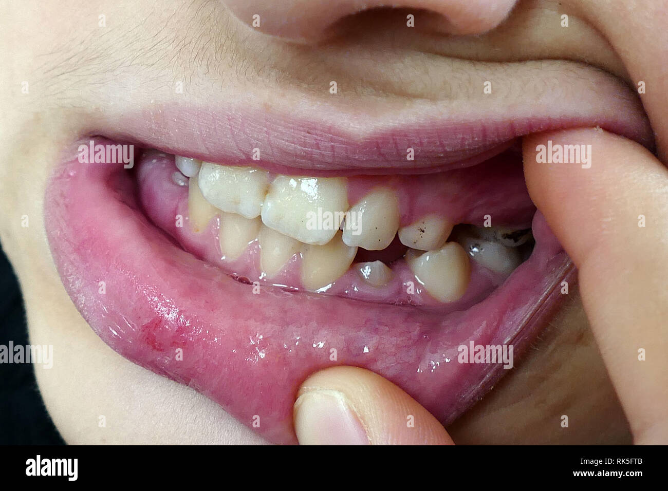 Sante Bucco Dentaire Le Tartre Et Les Taches Noires Sur Les Dents Photo Stock Alamy