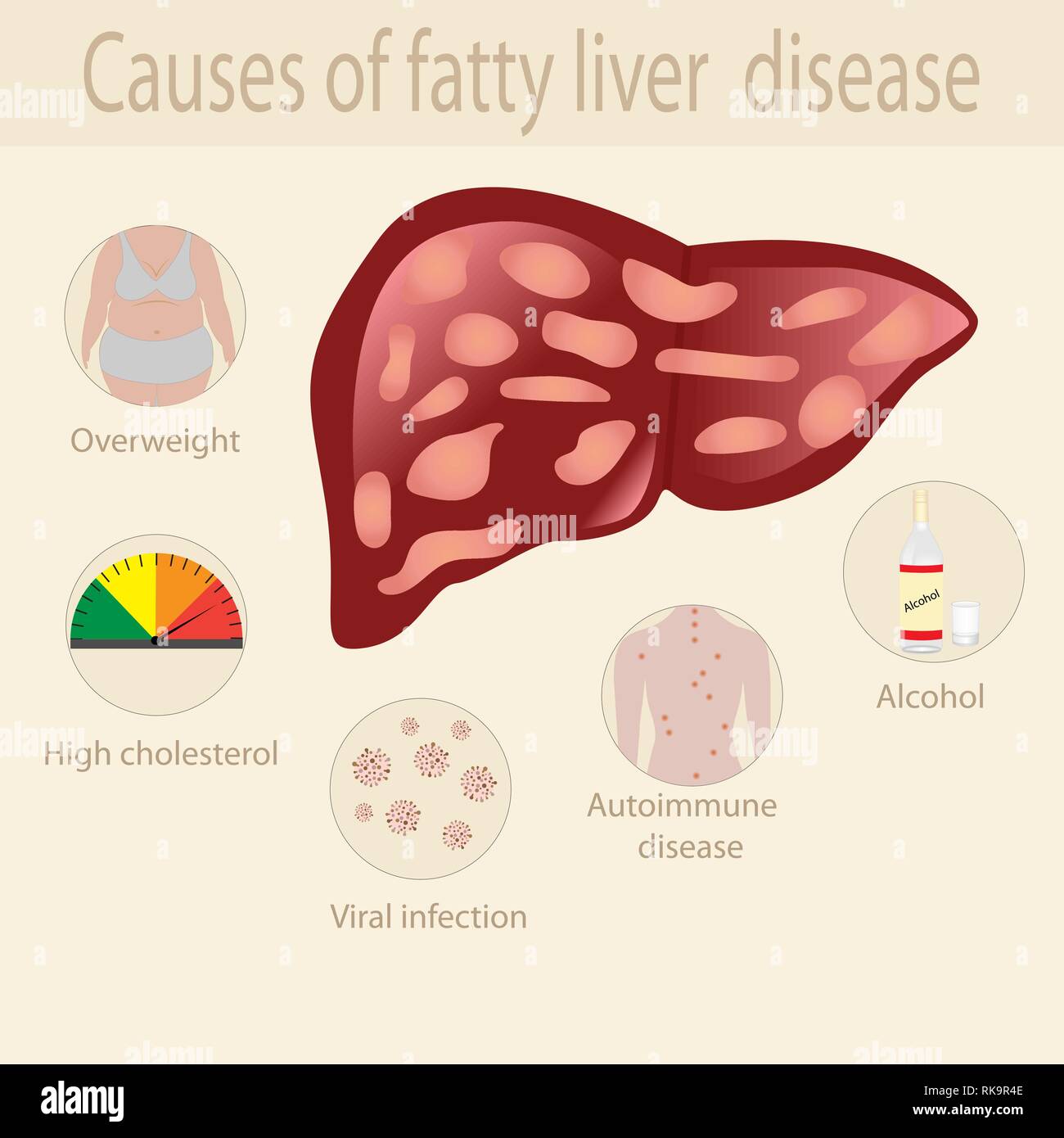 Causes de la maladie du foie gras des infographies Image Vectorielle ...