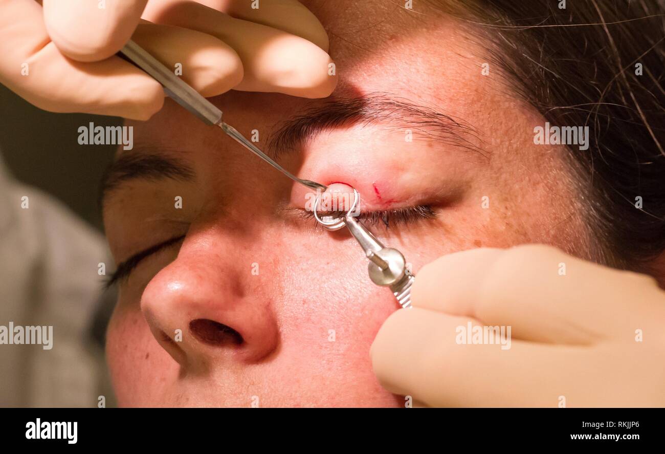 Chalazion Banque D Image Et Photos Alamy