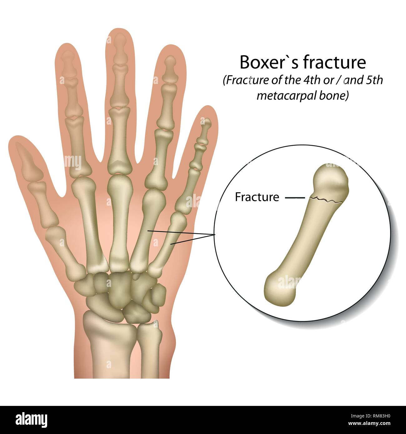 L'os du boxeur fracture main vector illustration médicale Illustration de Vecteur