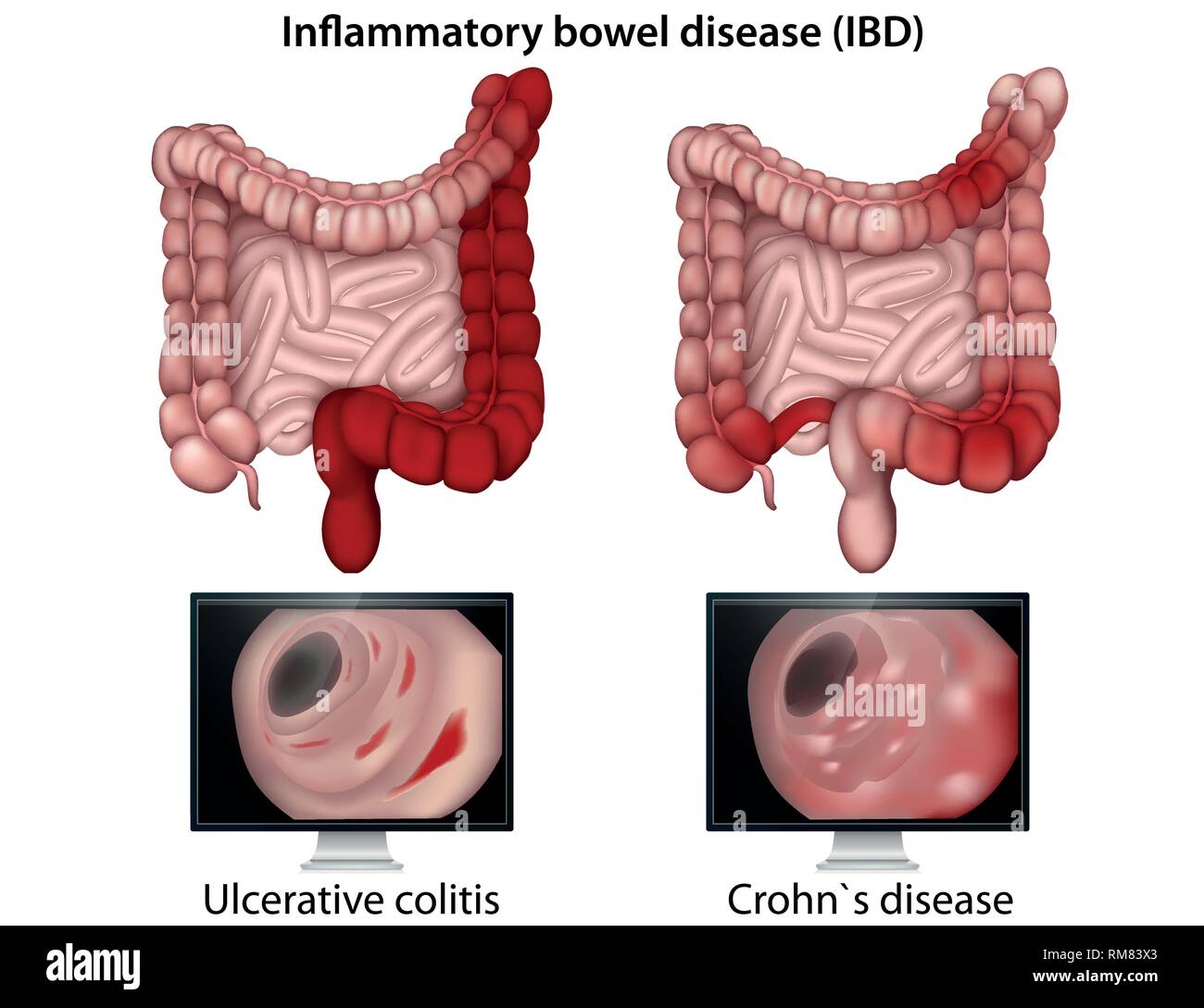 Inflammytory l'intestin medical vector illustration sur fond blanc Illustration de Vecteur