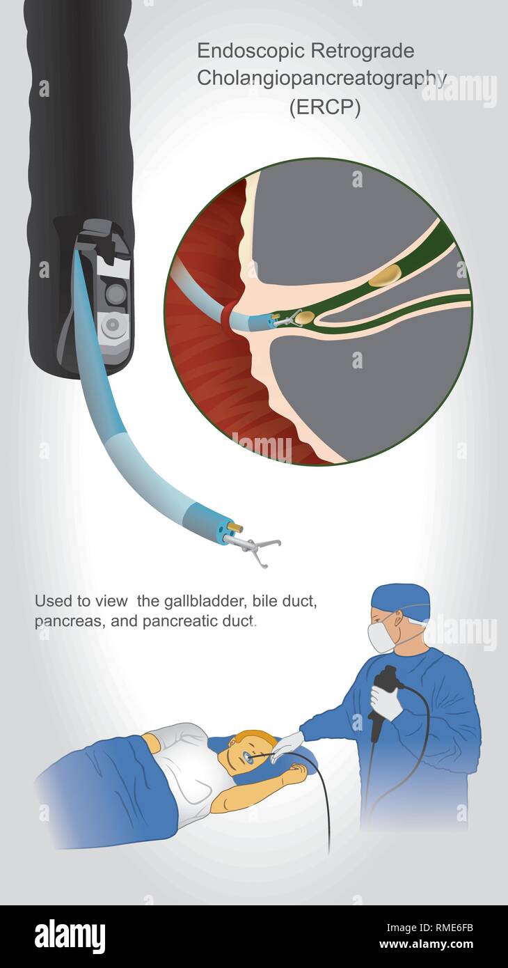 Cholangio-pancréatographie rétrograde endoscopique (CPRE) est une enquête utilisée pour visualiser et, le cas échéant, la biopsie, vésicule biliaire, pancréas, voies biliaires une Illustration de Vecteur