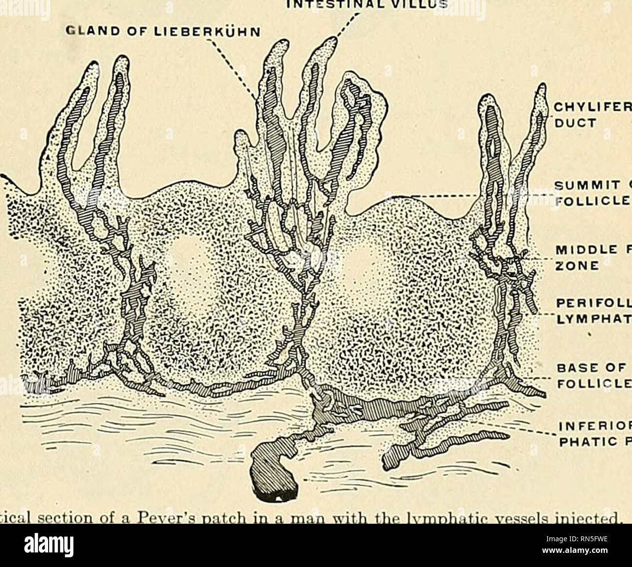 . Anatomie, descriptif et appliquée. L'anatomie. Fig. 1039.-surface libre d'un patch' Peyer. (Après Quain.) les bateaux, qui forment un plexus abondante autour de chaque follicule et dégagent des branches fines qui imprègnent les tissus lymphoïdes dans l'intérieur du follicule. Le plexus lactée qui se retrouvent tout au long de l'intestin grêle sont particulièrement abondants autour de ces patchs : ici ils forment des plexus riches avec les sinus autour des glandes (Fig. 1024). Dans la fièvre typhoïde il y a ulcera- tion des plaques de Peyer. CHYLI FERGUS. Fig. 1040.-section verticale d'un patch de Peyer avec les lymphatiques injectés Banque D'Images