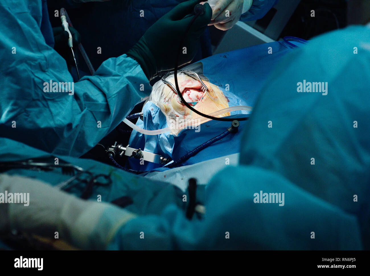 Les neurochirurgiens effectuer une chirurgie pour une tumeur au cerveau d'accise Banque D'Images