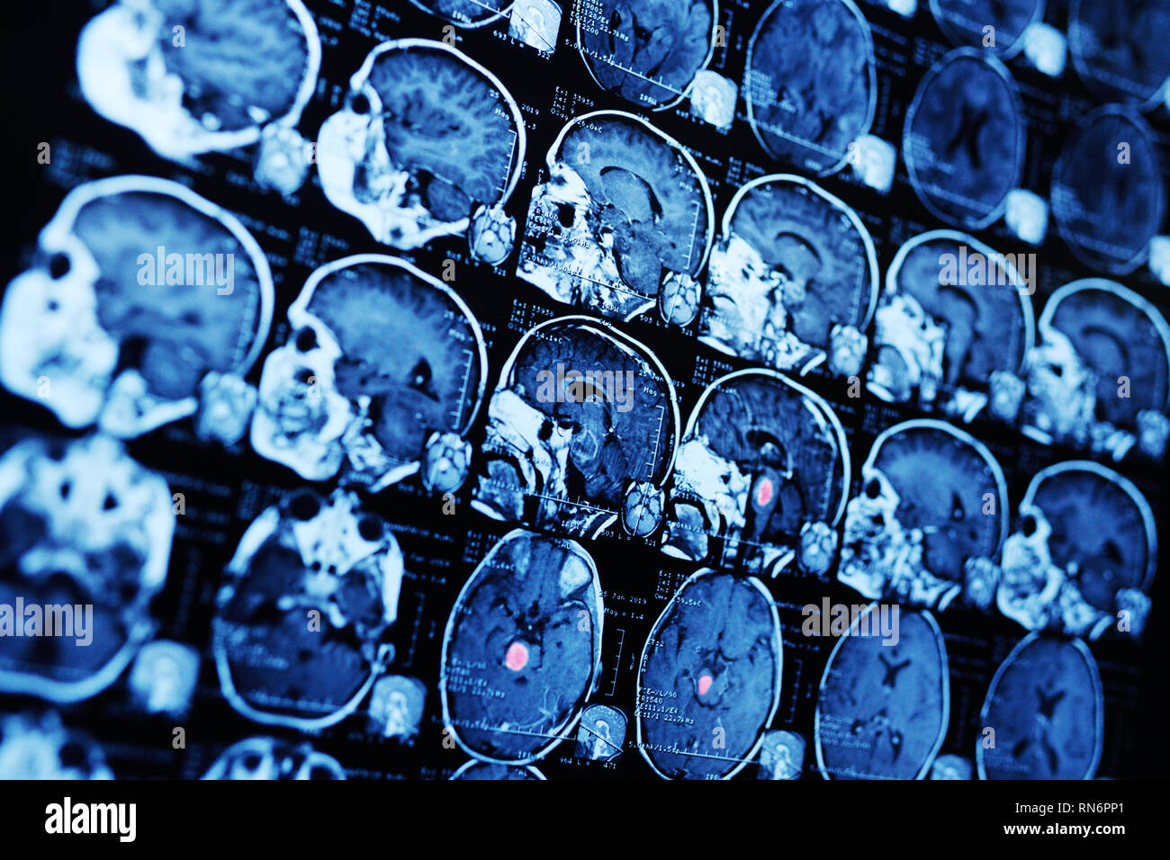 Lecture de l'image par résonance magnétique IRM d'un patient atteint d'une tumeur dans le tronc cérébral. Banque D'Images