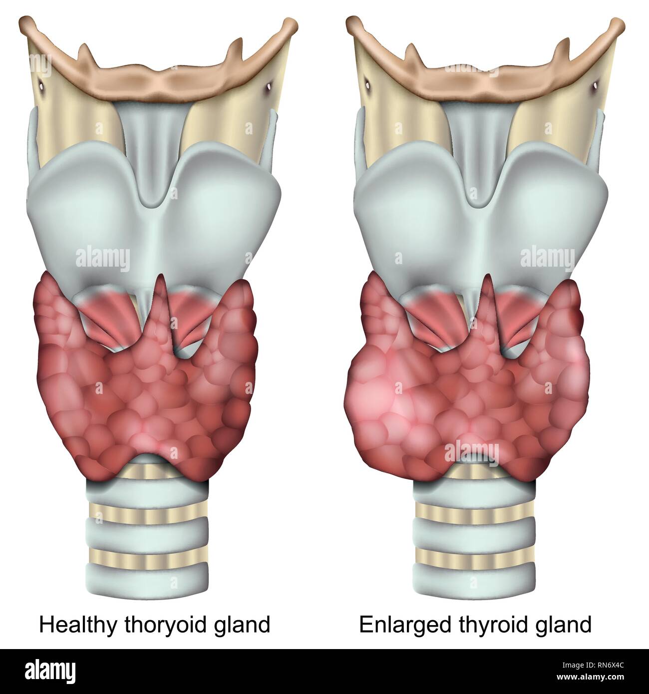 Glande thyroïde élargie médicale 3d vector illustration isolé sur fond blanc Illustration de Vecteur