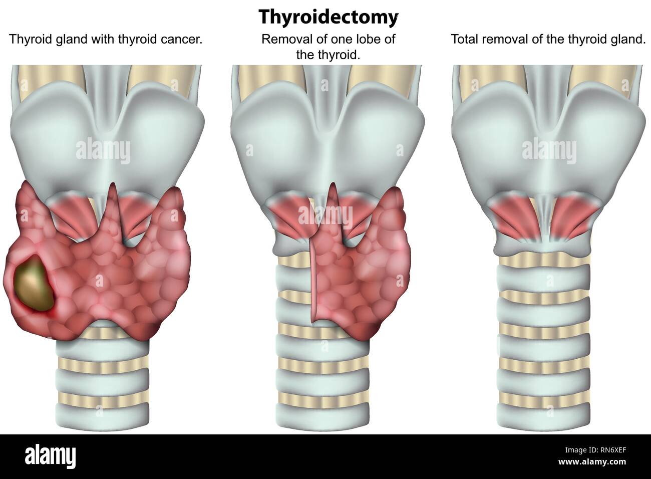La thyroïdectomie thyroïde médicale 3d vector illustration sur fond blanc Illustration de Vecteur