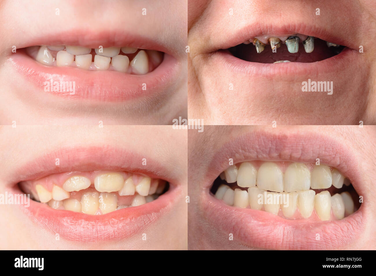 Un ensemble de quatre photographies de personnes avec des courbes et des dents pourries 2019 Banque D'Images