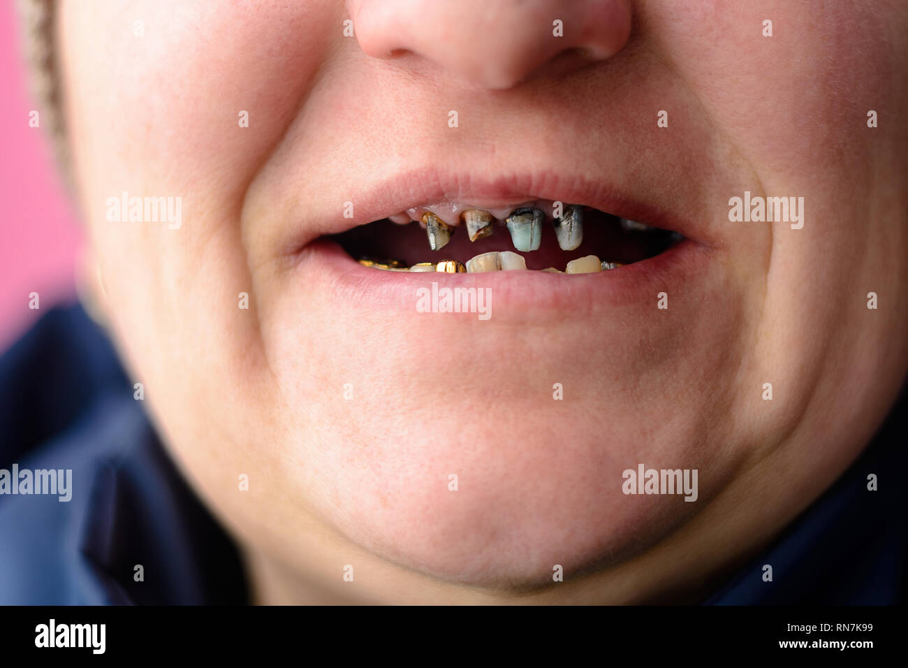 Close-up of a woman's face aux dents pourries et de la mort 2019 Banque D'Images