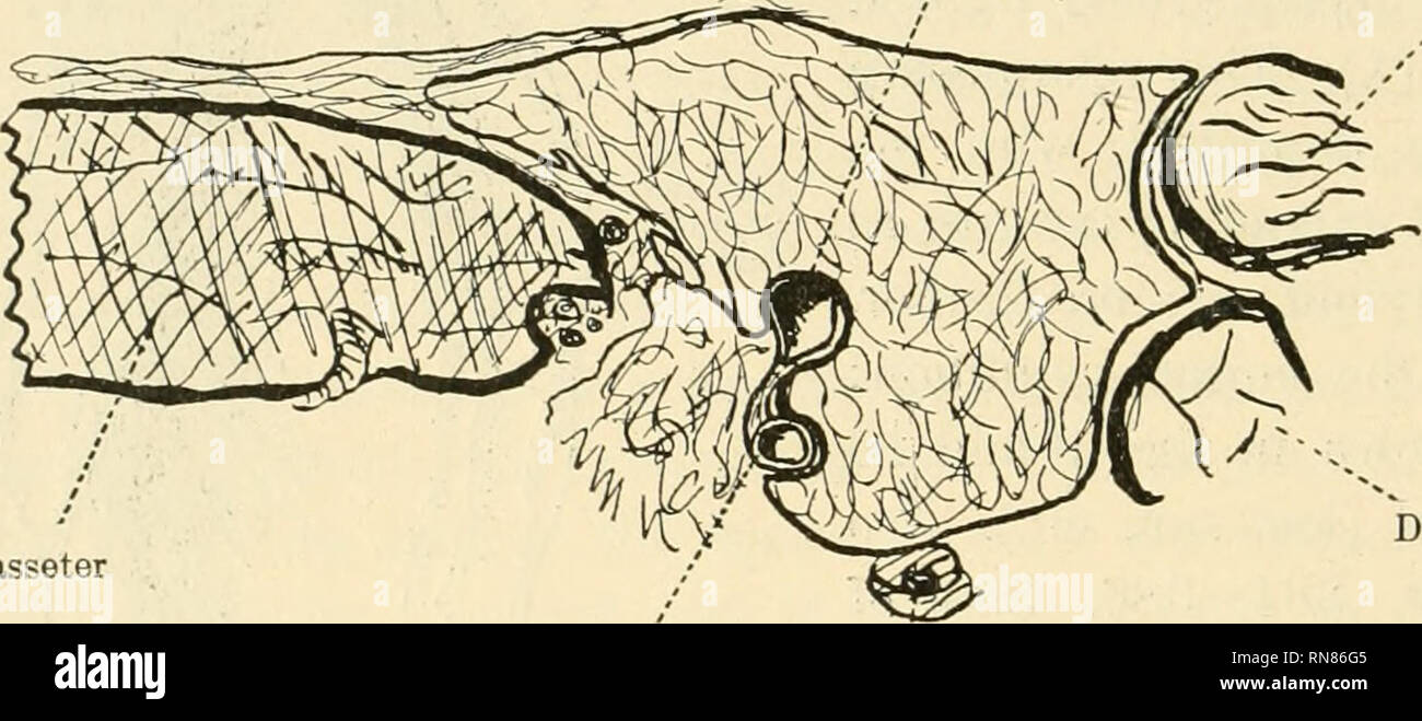 . Anatomischer Anzeiger. L'anatomie, l'Anatomie Comparée ;, comparatif. 86 pour la et la styloïde zone quelque peu semblable à l'étroit bord antérieur de l'Sterno-Mastoid. La veine Temporo-Mandibular poursuit son cours sur la sur- face profonde de la glande. Il est généralement décrit comme étant tout à fait enterré dans la glande en compagnie de l'artère carotide externe. Nos observations nous ont montré que ce n'est pas le cas et que les deux de ces navires vraiment exécuter dans les rainures sur la profonde de la glande, l'artère pour un cours beaucoup plus courte que la veine (voir fig, 4). La quantité de gland substanc Banque D'Images