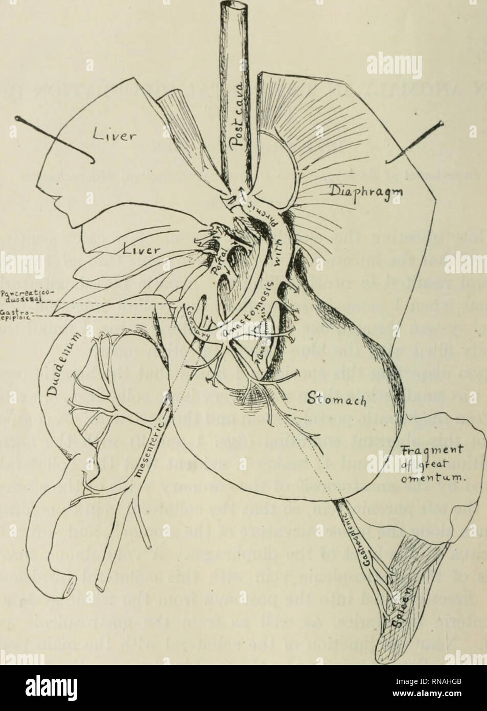 . Le dossier anatomique. Anatomie Anatomie ;. 80 WHIPPLE INEZ WILDER. FiK- 1 N'ontral Vue de dissection de cat anormale montrant de l'anastomose tiic et coronaires veines splénique avec le k"ft, phrénique entraînant la pour- mation d'un .garantie directe de drainage le portail système dans le postcava. Le diaphragme est représenté comme de la fente à l'postcava midventral line, le foie est levé, et le foie et le diaphragme sont tirées en avant pour afficher les liens du sang-navires.. Veuillez noter que ces images sont extraites de la page numérisée des images qui peuvent avoir été Banque D'Images