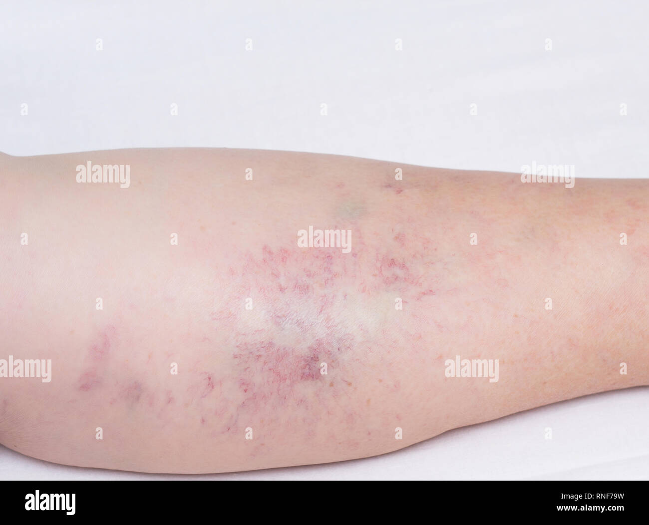 Maladie de la jambe rouge et gonflee Banque de photographies et d