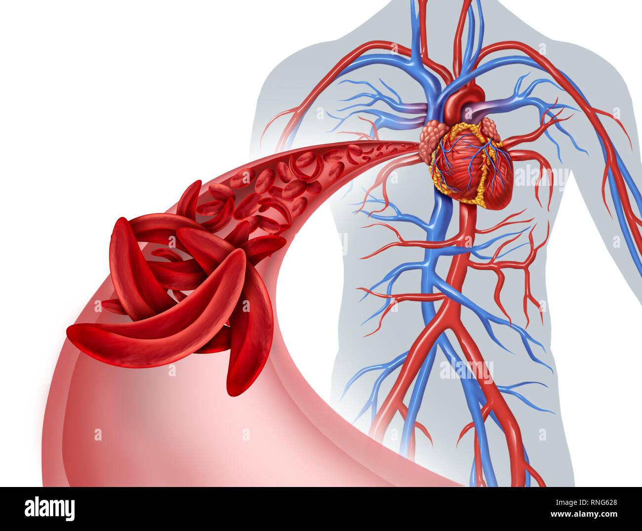 La drépanocytose anémie et blocage de la circulation du cœur comme une maladie avec l'hémoglobine normale et anormale dans une artère de l'anatomie à coeur. Banque D'Images