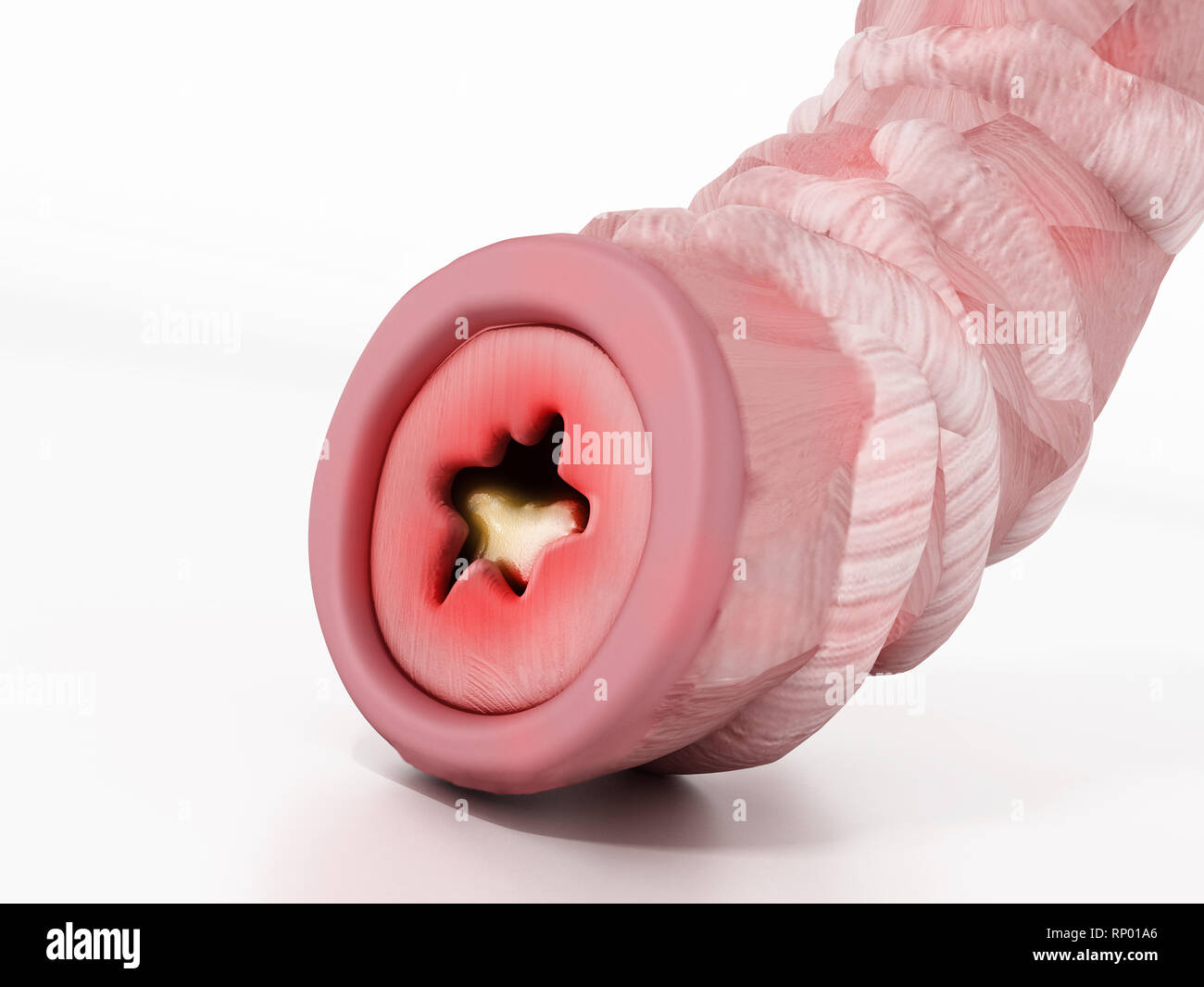 L'obstruction du tube bronchique illustration représentant l'asthme. 3D illustration. Banque D'Images