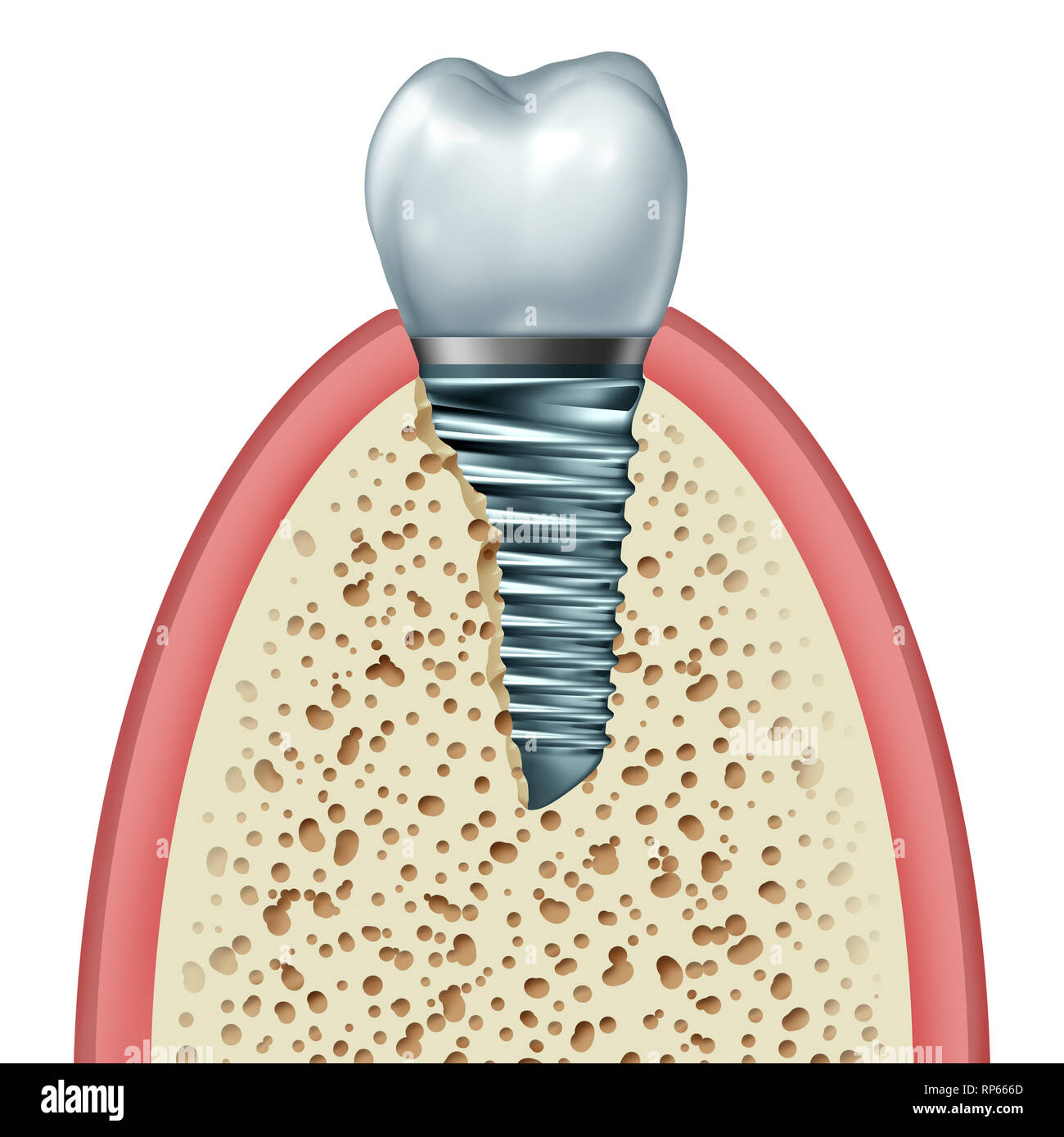 Les Implants dentaires intraosseux ou à l'intérieur de la prothèse dentaire de l'os de la mâchoire et du tissu des gencives avec une couronne d'orthodontie abutement et vis en métal. Banque D'Images