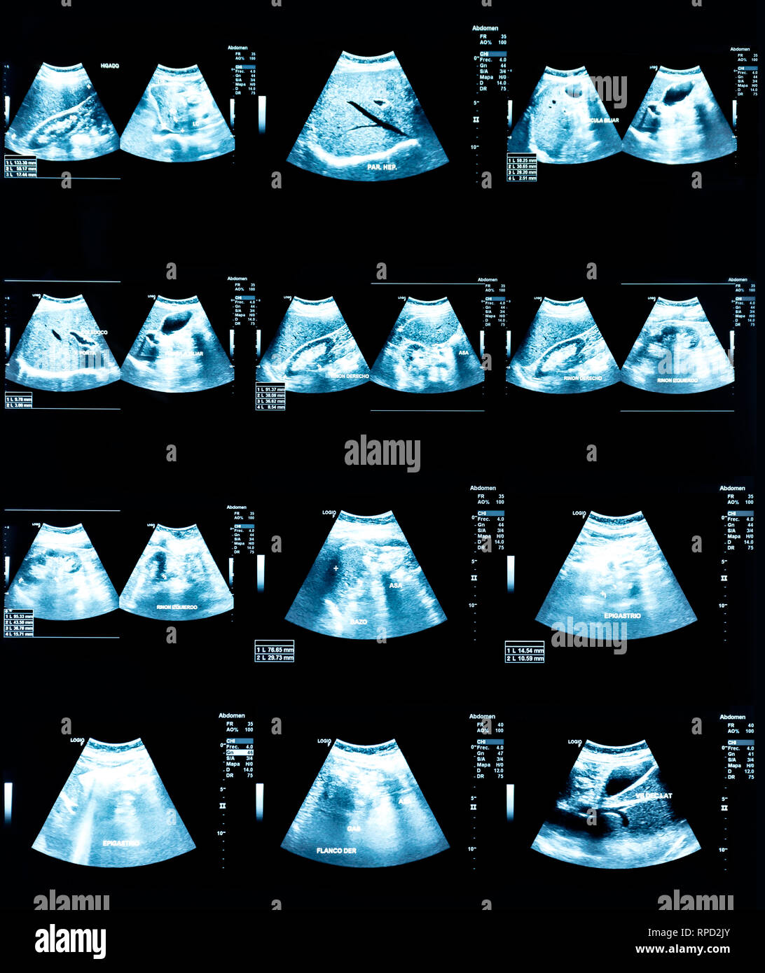 Image échographie (ultrasons) de l'abdomen Banque D'Images