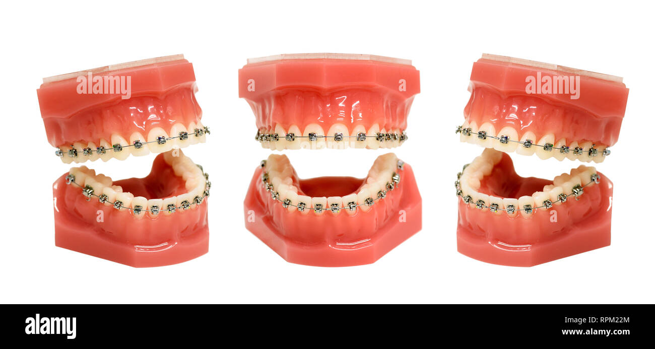 Modèle de dents, mâchoires avec appareil dentaire câblé métallique installé, isolé sur fond blanc et vue sous trois angles différents Banque D'Images