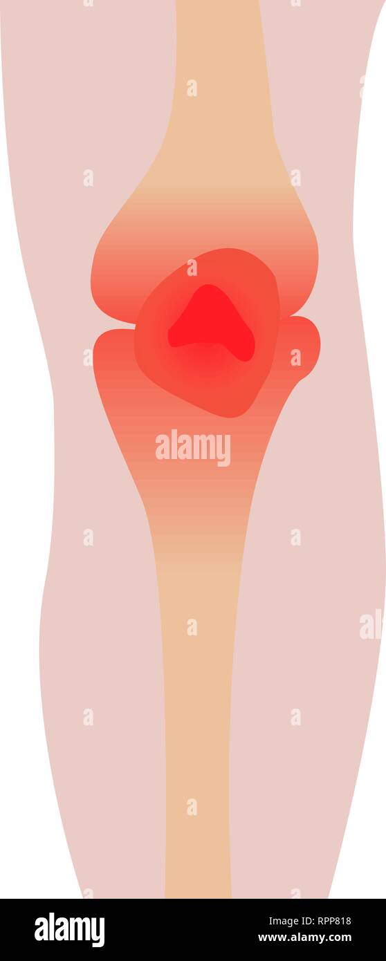 Blessure au genou inflammation rougeur vector illustration Image ...