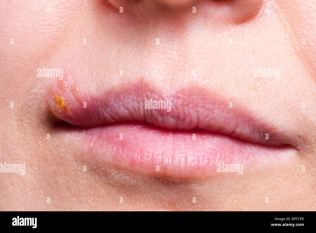 L'herpès sur la lèvre macro close up Banque D'Images